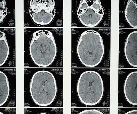 Negative Health Complications Associated With TBI and How to Prevent Them